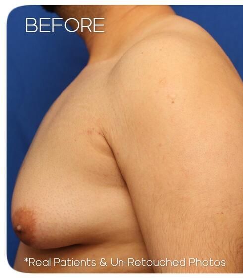 Gynecomastia Before & After
