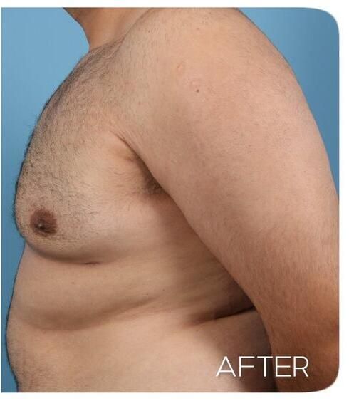 Gynecomastia Before & After