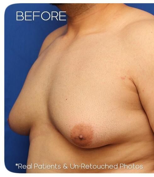 Gynecomastia Before & After