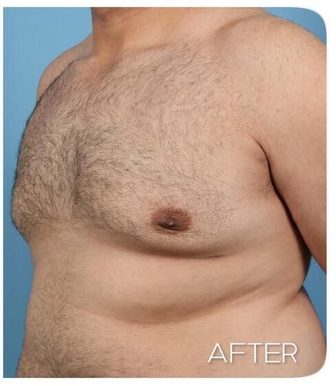 Gynecomastia Before & After