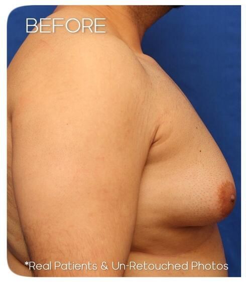 Gynecomastia Before & After