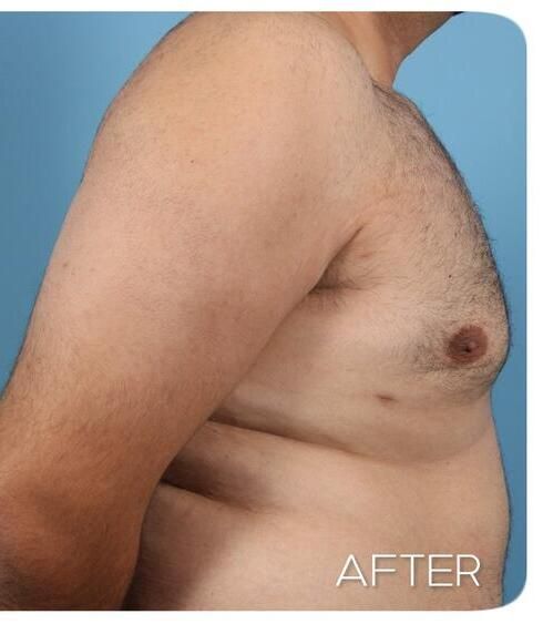 Gynecomastia Before & After