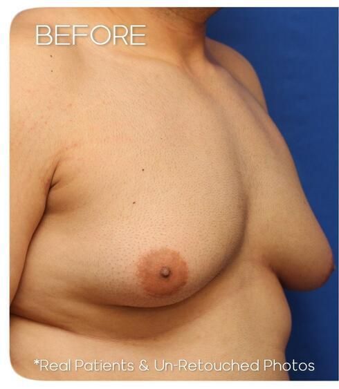 Gynecomastia Before & After
