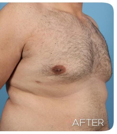 Gynecomastia Before & After