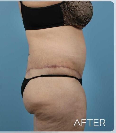 Body Arm Thigh Lifts Before & After