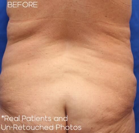 Body Arm Thigh Lifts Before & After