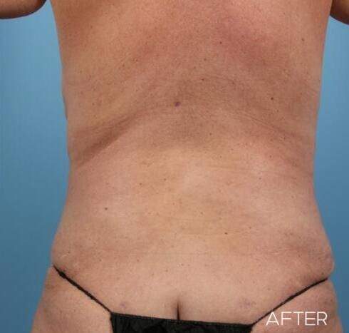 Body Arm Thigh Lifts Before & After