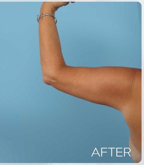 Body Arm Thigh Lifts Before & After