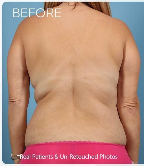 Body Arm Thigh Lifts Before & After