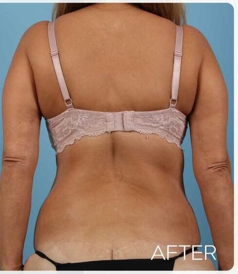 Body Arm Thigh Lifts Before & After