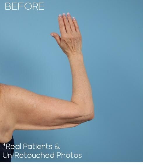 Body Arm Thigh Lifts Before & After