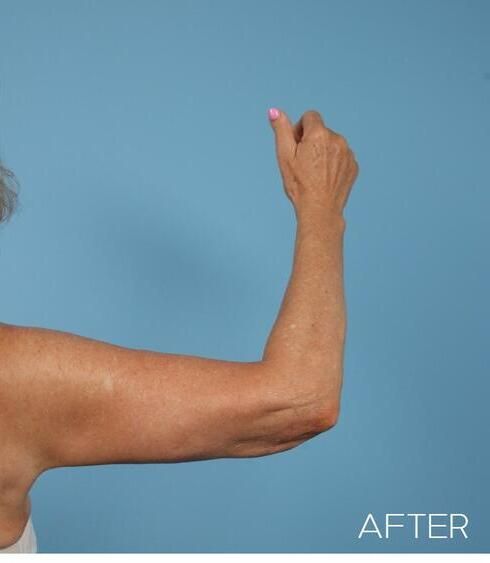 Body Arm Thigh Lifts Before & After