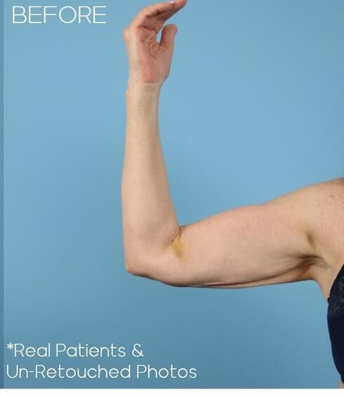 Body Arm Thigh Lifts Before & After