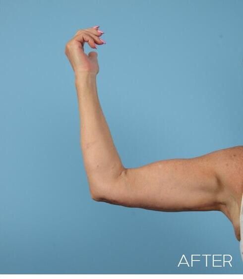 Body Arm Thigh Lifts Before & After