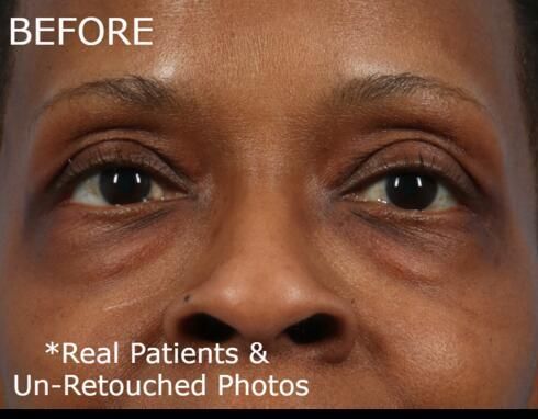 Blepharoplasty Before & After