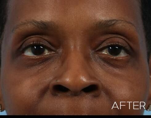 Blepharoplasty Before & After