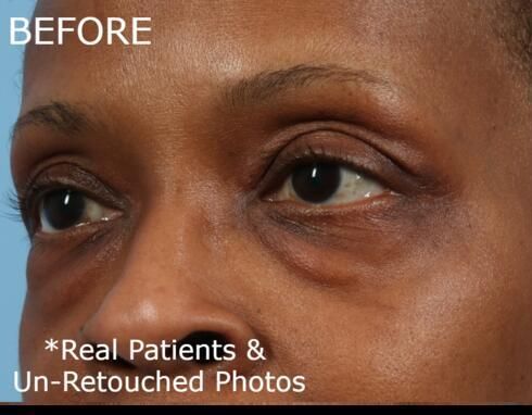 Blepharoplasty Before & After