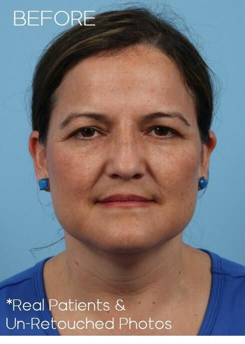 Blepharoplasty Before & After