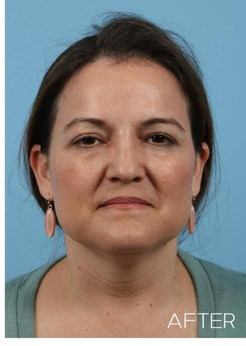 Blepharoplasty Before & After