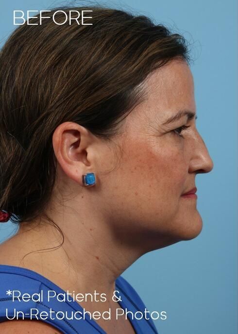 Blepharoplasty Before & After