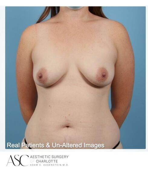 Mommy Makeover Before & After