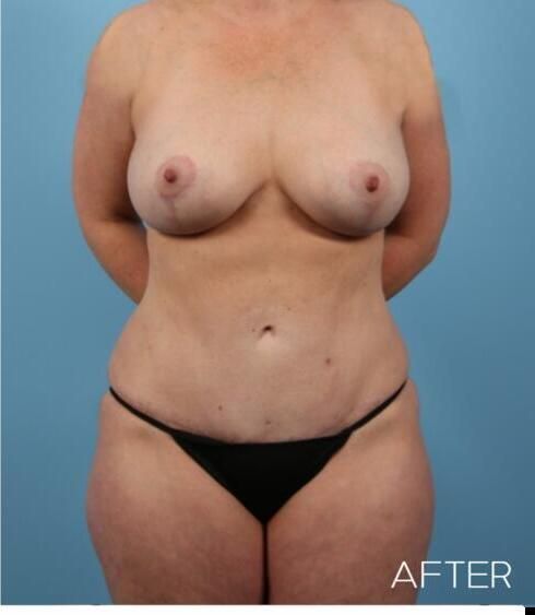 Mommy Makeover Before & After