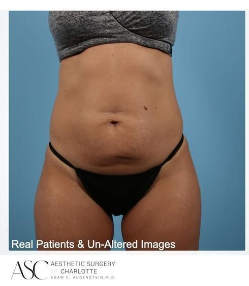 Abdominoplasty Before & After