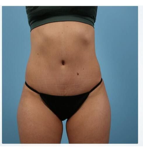 Abdominoplasty Before & After