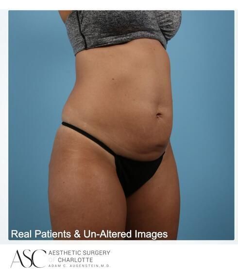 Abdominoplasty Before & After