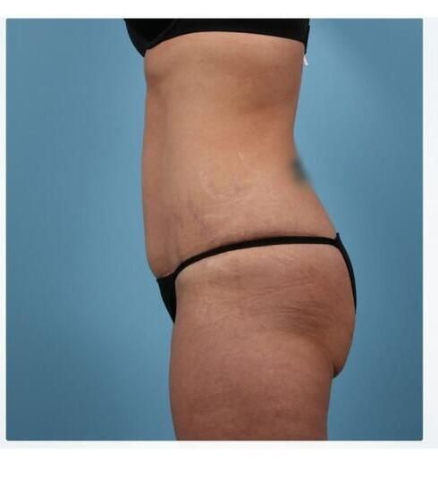 Abdominoplasty Before & After