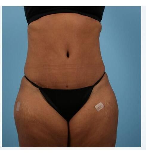Abdominoplasty Before & After