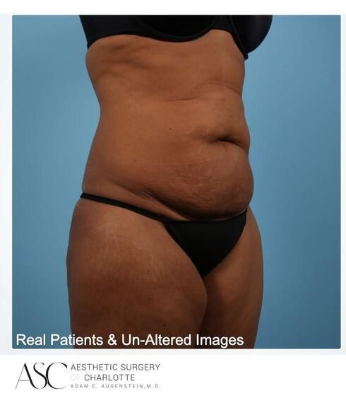 Abdominoplasty Before & After