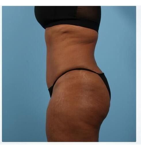 Abdominoplasty Before & After