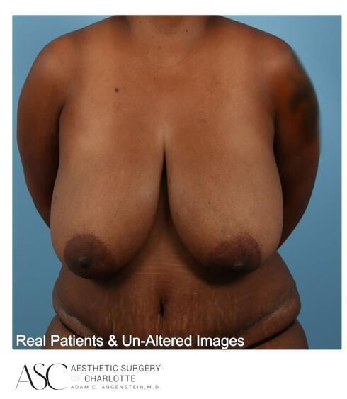 Abdominoplasty Before & After