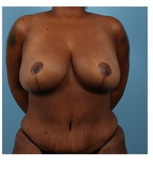 Abdominoplasty Before & After