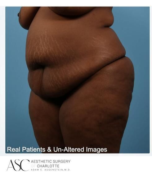 Abdominoplasty Before & After