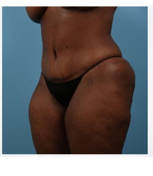 Abdominoplasty Before & After