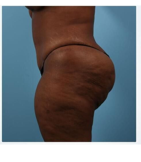 Abdominoplasty Before & After