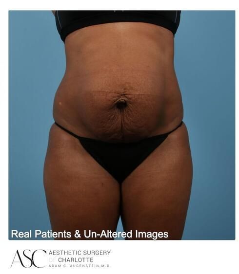 Abdominoplasty Before & After