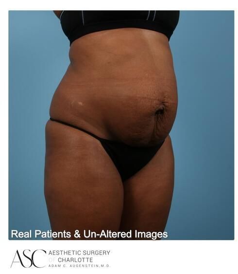 Abdominoplasty Before & After