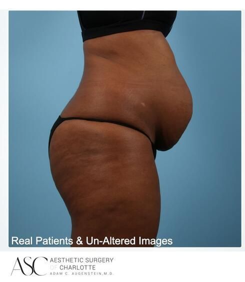 Abdominoplasty Before & After