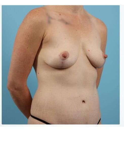 Abdominoplasty Before & After