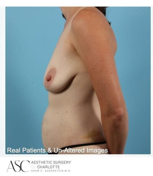 Abdominoplasty Before & After