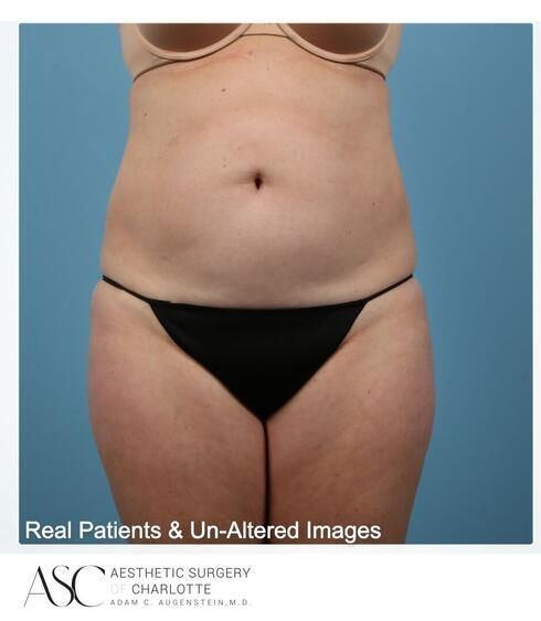 Abdominoplasty Before & After