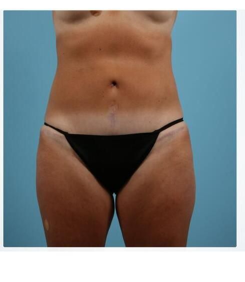 Abdominoplasty Before & After
