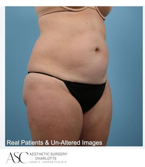 Abdominoplasty Before & After