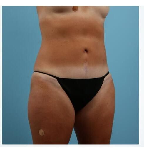 Abdominoplasty Before & After