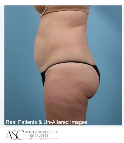 Abdominoplasty Before & After