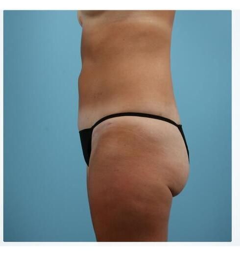 Abdominoplasty Before & After