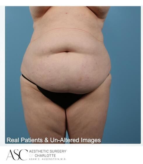 Abdominoplasty Before & After